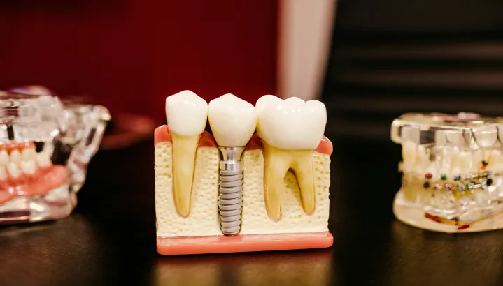 Dental Implant 3