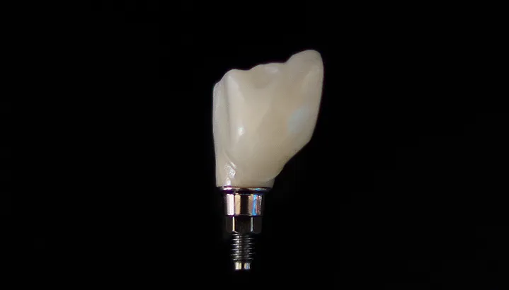 Dental Implant 2