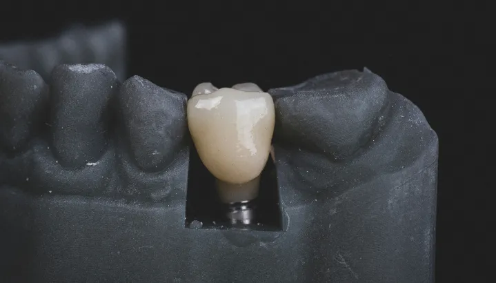 Dental Implant 4