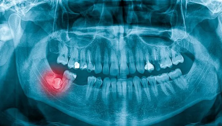 Wisdom Tooth Removal2